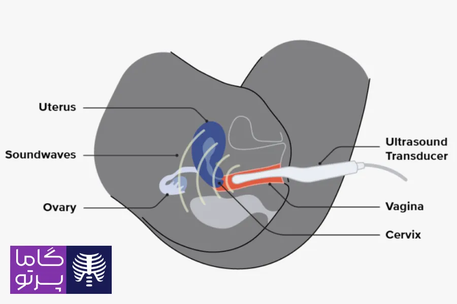 سونوگرافی ترانس واژینال چیست؟ - گاما پرتو