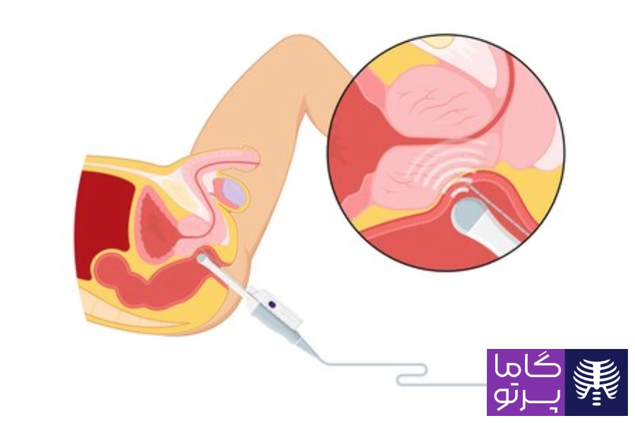 سونوگرافی ترانسرکتال (از راه مقعد) برای سونوگرافی پروستات - گاما پرتو
