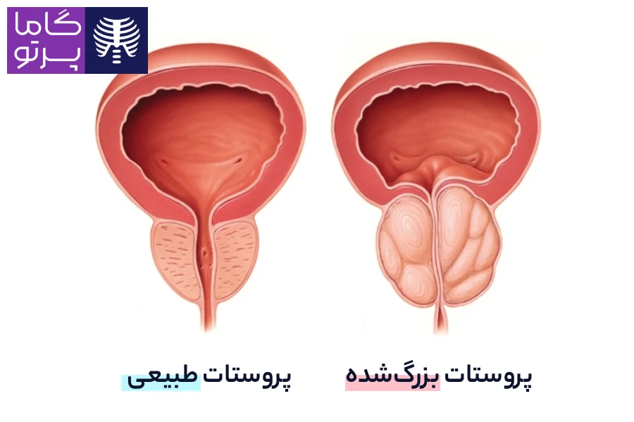 طبیعی پروستات و روستات بزرگ شده - سونوگرافی پروستات - گاما پرتو