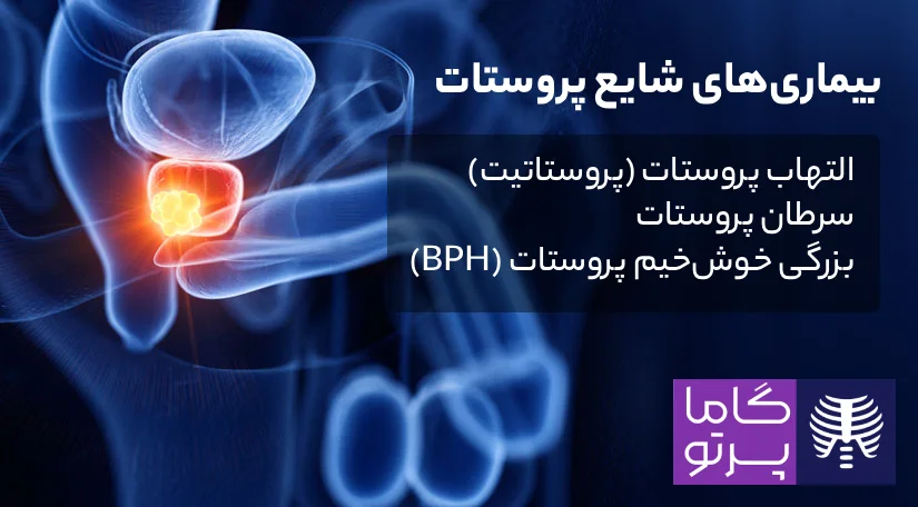 بیماریها و مشکلات شایع پروستات - گاما پرتو