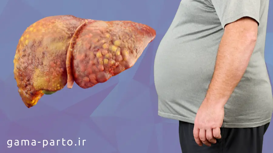 روشهای تشخیص کبد چرب چیست؟ - گاما پرتو