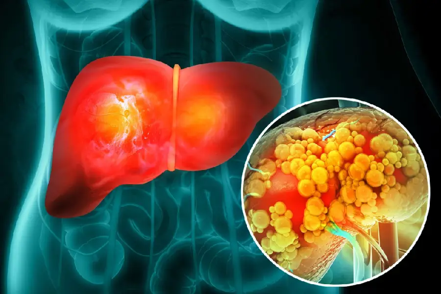 علائم کبد چرب | راهنمای تشخیص کبد چرب - گاما پرتو