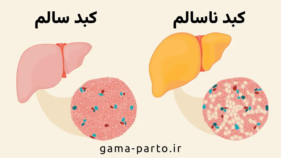 کبد چرب - کبد سالم - گاما پرتو