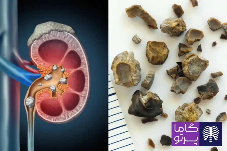 سنگ کلیه چیست و چگونه تشکیل میشود؟ - گاما پرتو