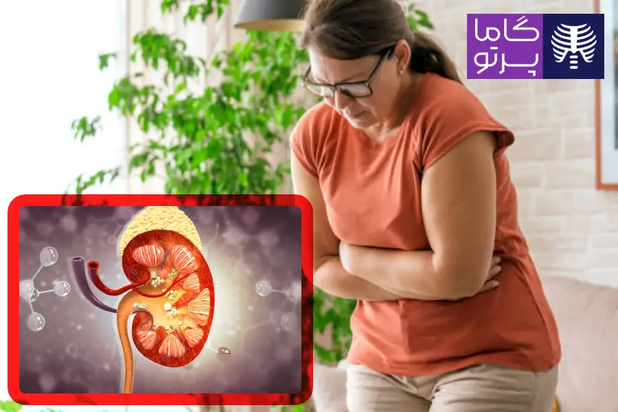 علائم و نشانههای سنگ کلیه - گاما پرتو