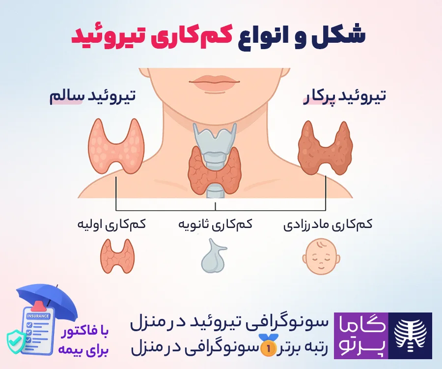 کم کاری تیروئید و انواع آن - گاما پرتو