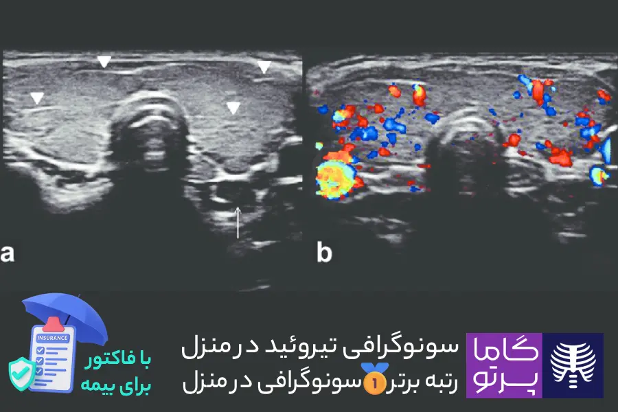 تشخیص کم کاری تیروئید با سونوگرافی در منزل گاما پرتو با رسید بیمه