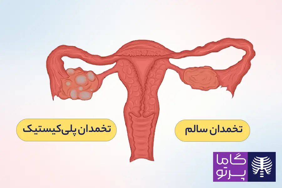 تنبلی تخمدان چیست؟ علل و علائم تنبلی تخمدان + روش های تشخیص - گاما پرتو