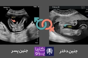 تفاوت جنین دختر و پسر در سونوگرافی - گاما پرتو