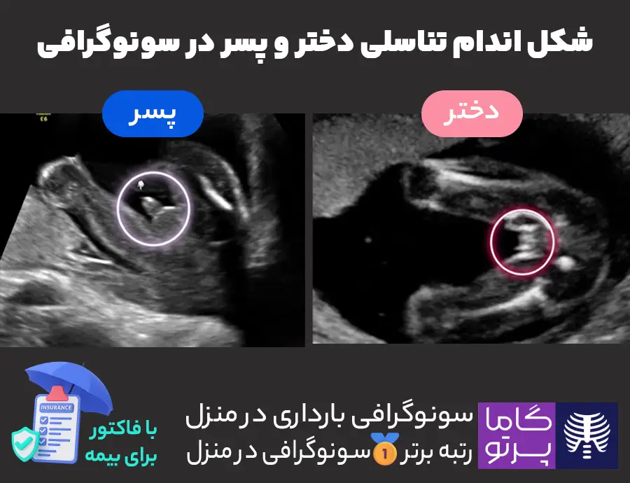 شکل اندام تناسلی دختر و پسر در سونوگرافی - گاما پرتو