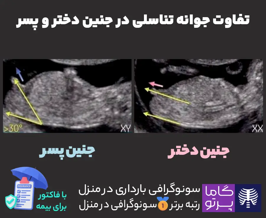 تفاوت جوانه تناسلی در جنین دختر و پسر - سونوگرافی بارداری - گاما پرتو