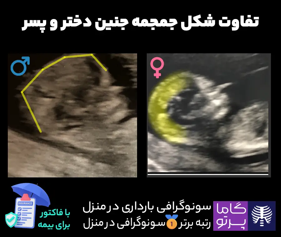 تفاوت شکل جمجمه جنین دختر و پسر در سونوگرافی - گاما پرتو