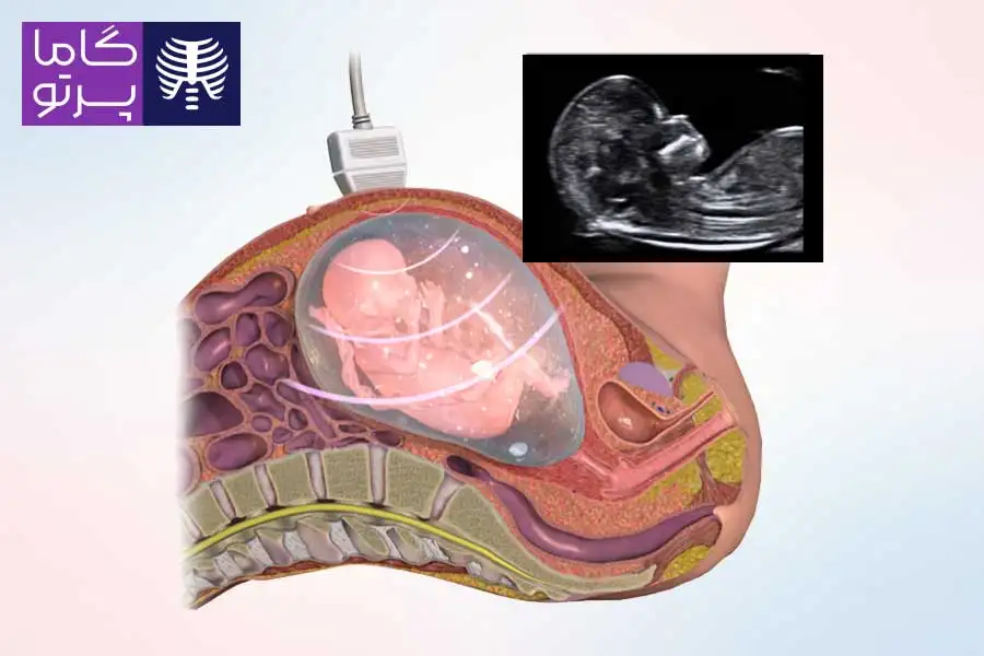 سونوگرافی NT چیست و چه کاربردی دارد؟ - گاما پرتو