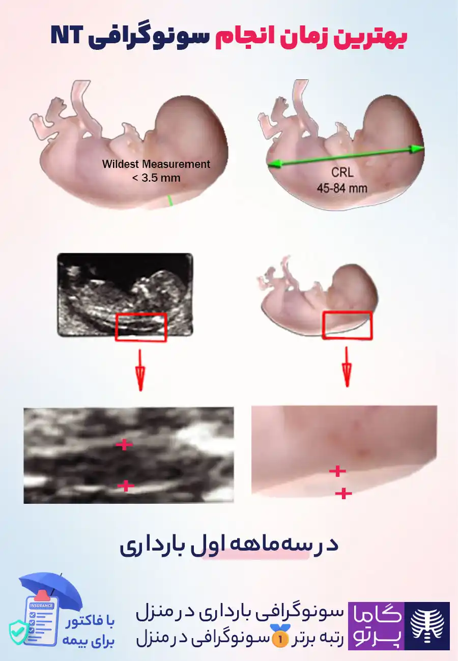 بهترین زمان انجام سونوگرافی NT - گاما پرتو