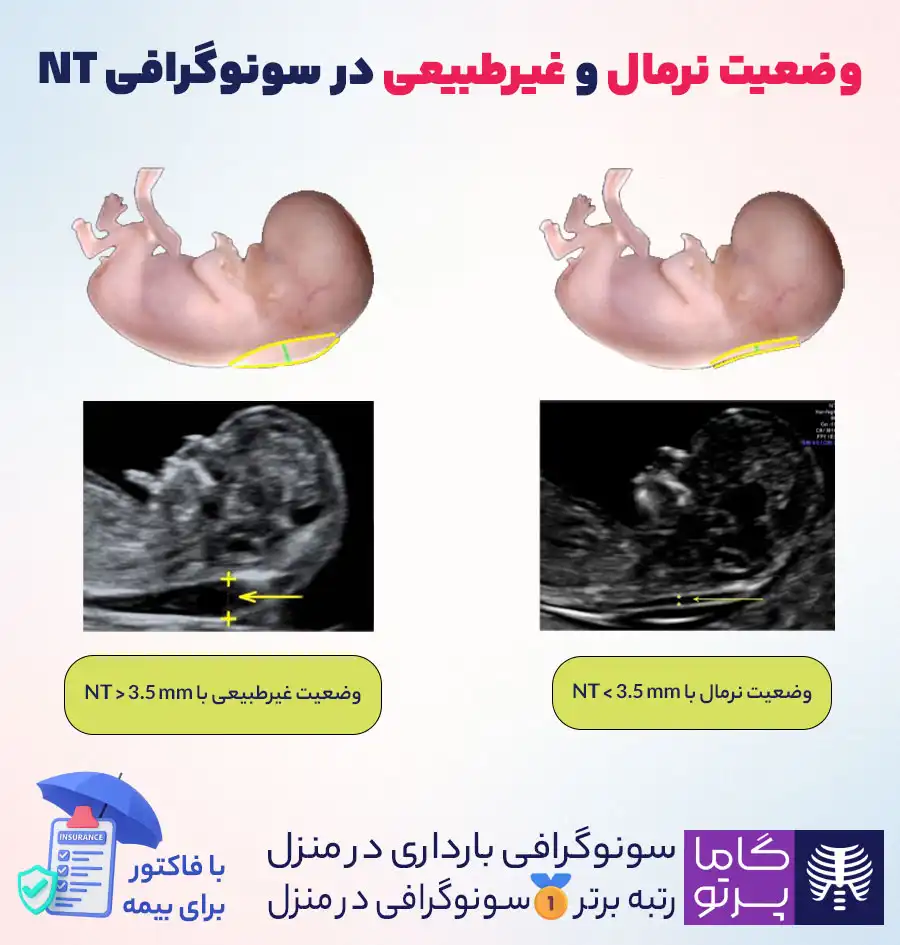 وضعیت نرمال و غیرطبیعی در سونوگرافی NT - گاما پرتو