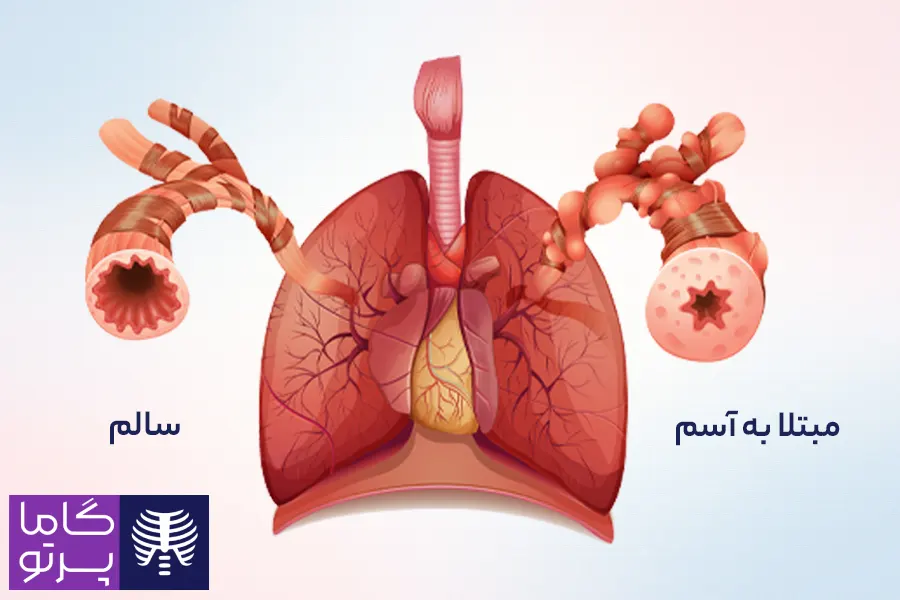آسم چیست؟ علت، علائم و روش درمان آسم - گاما پرتو
