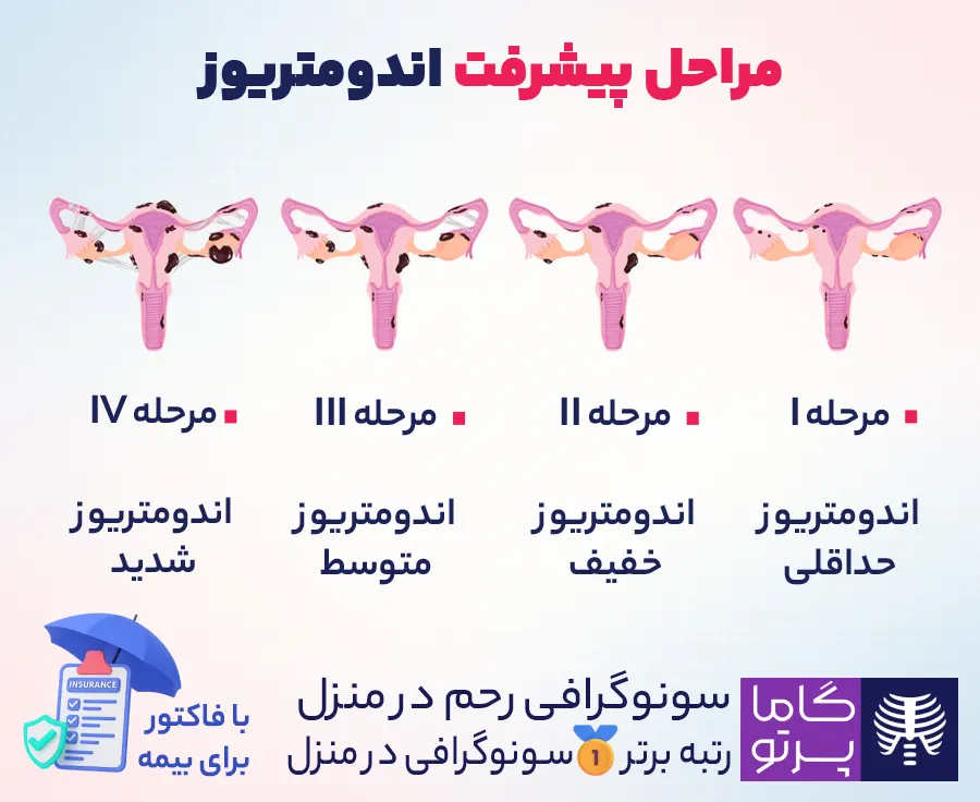 مراحل پیشرفت اندومتریوز - گاما پرتو
