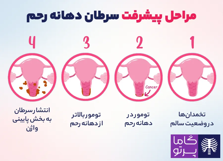 پیشرفت سرطان دهانه رحم در 4 مرحله - گاما پرتو