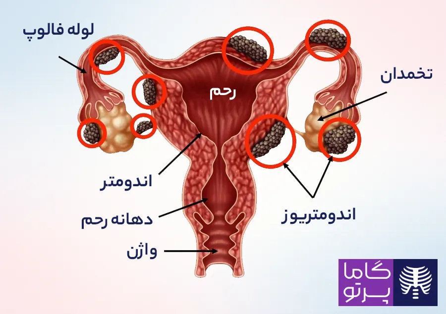 اندومتریوز چیست؟ علائم و نحوه تشخیص صحیح آندومتریوز - گاما پرتو